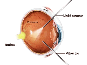 Vitrectomy:  The Most Common Method for Fixing Retinal Detachments
