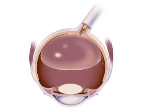 Understanding Face-Down Positioning After Retinal Surgery